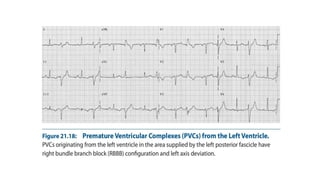 Comprehensive ECG Analysis and Management of Ventricular Premature ...