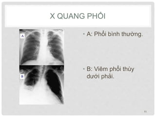 X QUANG PHỔI
• A: Phổi bình thường.
• B: Viêm phổi thùy
dưới phải.
11
 