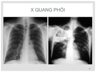 X QUANG PHỔI
12
 