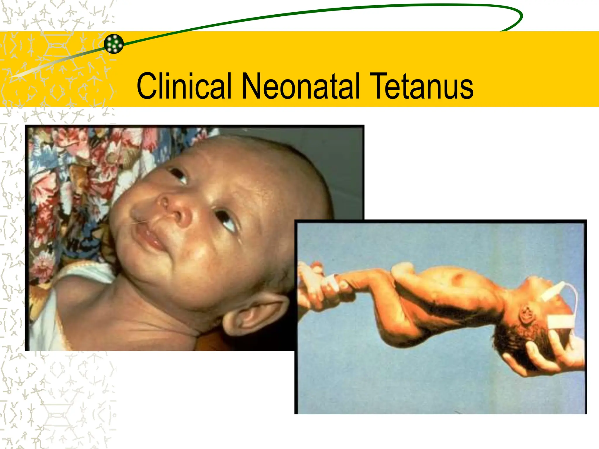 Clinical Neonatal Tetanus
 