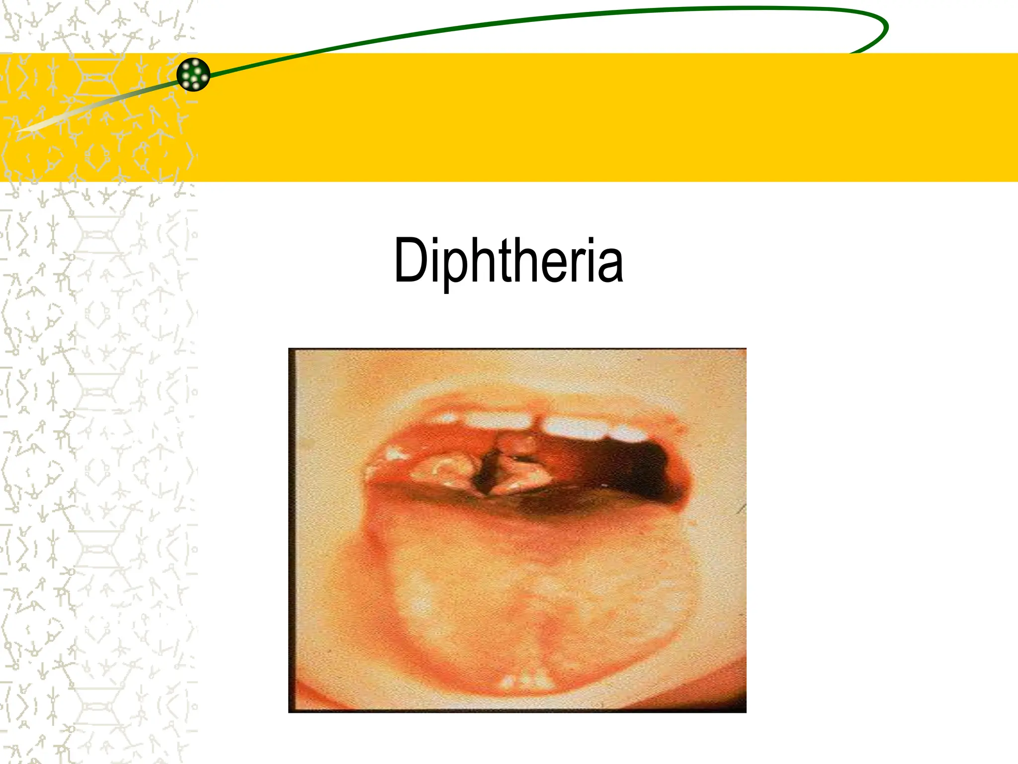 Diphtheria
Epidemiology and Prevention of Vaccine-
Preventable Diseases
National Immunization Program
Centers for Disease Control and Prevention
Revised March 2002
 