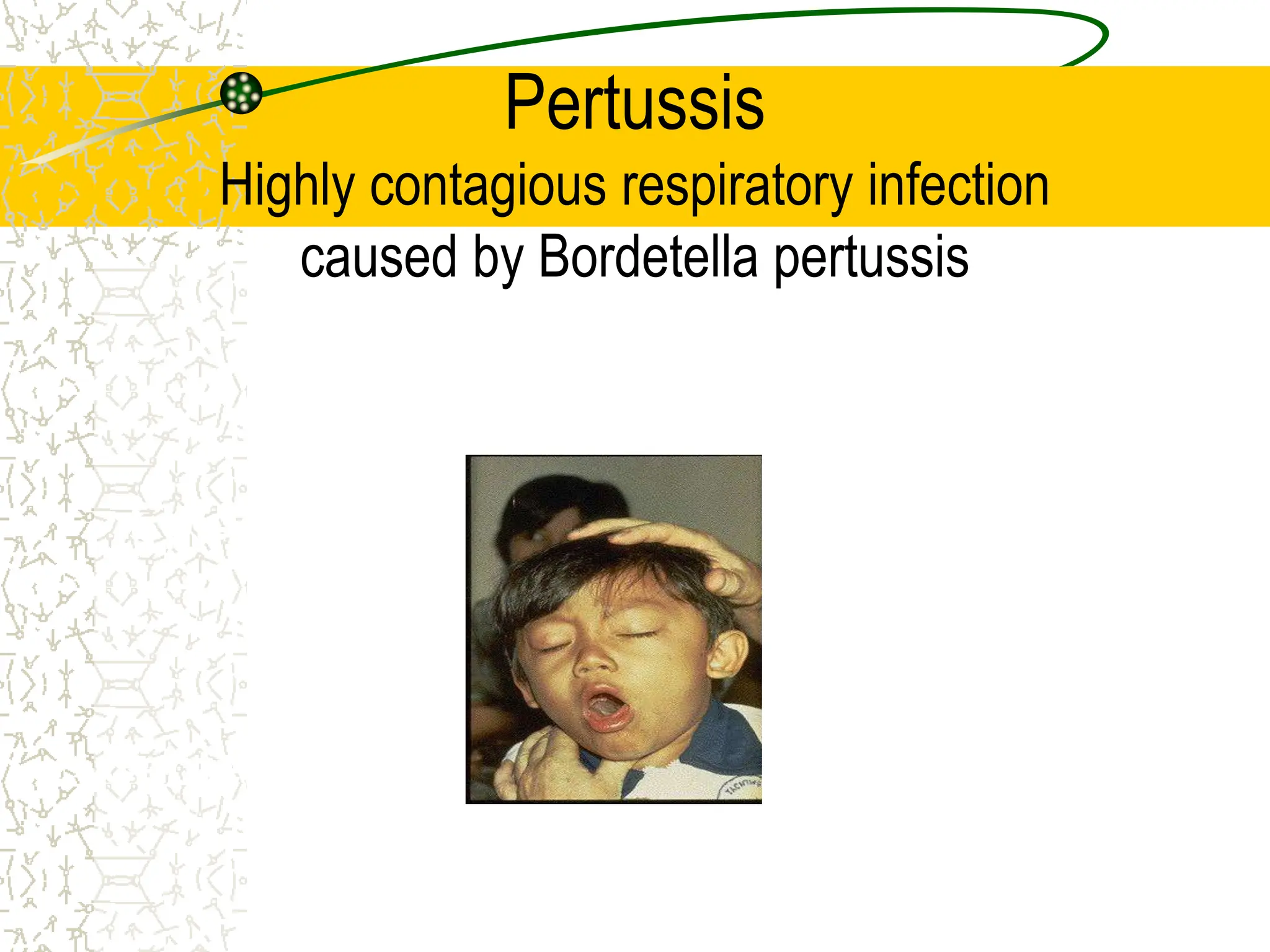 Pertussis
Highly contagious respiratory infection
caused by Bordetella pertussis
Epidemiology and Prevention of Vaccine-
Preventable Diseases
National Immunization Program
Centers for Disease Control and Prevention
Revised August 2002
 