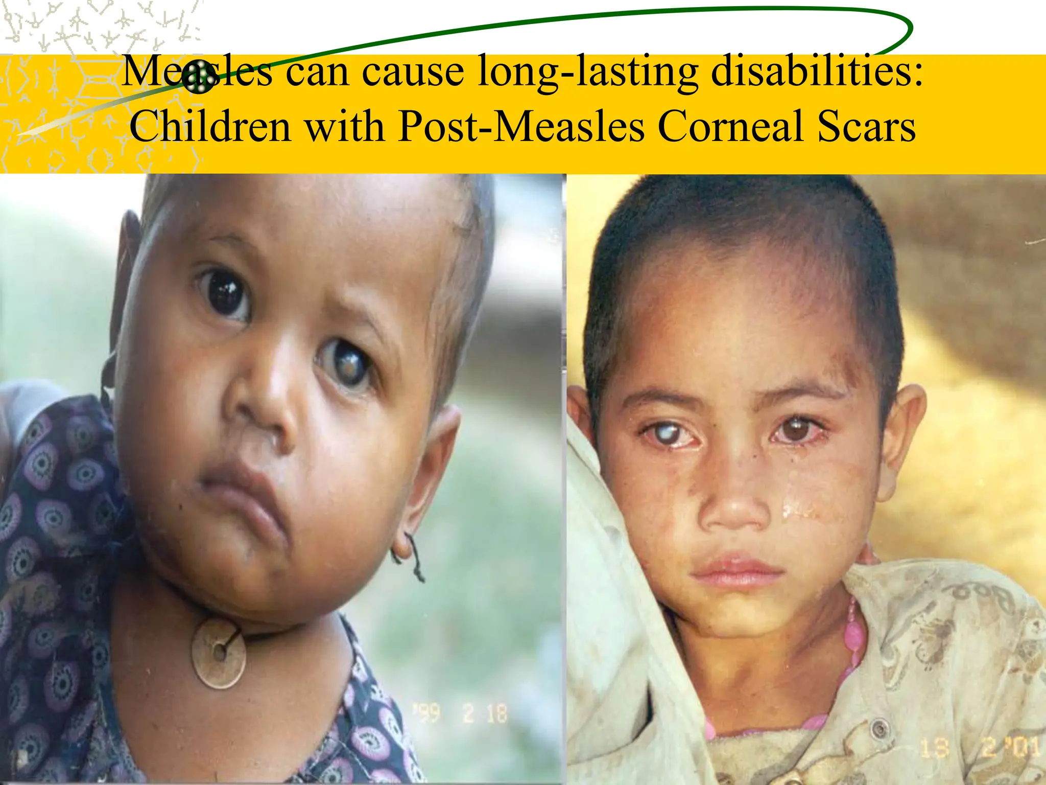 Measles can cause long-lasting disabilities:
Children with Post-Measles Corneal Scars
 