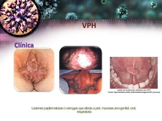 Clínica
Lesionespapilomatosasoverrugas queafectaapiel,mucosasano-genital, oral,
respiratoria
VPH
 