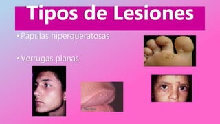 Tipos de Lesiones
• Pápulas hiperqueratosas
• Verrugas planas
 