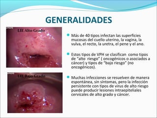 GENERALIDADES
Más de 40 tipos infectan las superficies
mucosas del cuello uterino, la vagina, la
vulva, el recto, la uretra, el pene y el ano.
Estos tipos de VPH se clasifican como tipos
de “alto riesgo” ( oncogénicos o asociados a
cáncer) y tipos de “bajo riesgo” (no
oncogénicos).
Muchas infecciones se resuelven de manera
espontánea, sin síntomas, pero la infección
persistente con tipos de virus de alto riesgo
puede producir lesiones intraepiteliales
cervicales de alto grado y cáncer.
LIE Alto Grado
LIE Bajo Grado
 