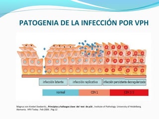 PATOGENIA DE LA INFECCIÓN POR VPH
Magnus von Knebel Doeberitz., Principios y hallazgos clave del test de p16 . Institute of Pathology. University of Heidelberg.
Alemania. HPV Today . Feb 2006 . Pág 12
 