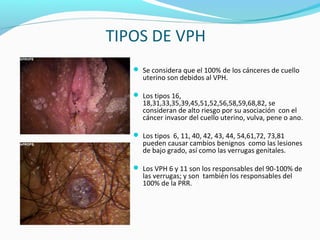 TIPOS DE VPH
 Se considera que el 100% de los cánceres de cuello
uterino son debidos al VPH.
 Los tipos 16,
18,31,33,35,39,45,51,52,56,58,59,68,82, se
consideran de alto riesgo por su asociación con el
cáncer invasor del cuello uterino, vulva, pene o ano.
 Los tipos 6, 11, 40, 42, 43, 44, 54,61,72, 73,81
pueden causar cambios benignos como las lesiones
de bajo grado, así como las verrugas genitales.
 Los VPH 6 y 11 son los responsables del 90-100% de
las verrugas; y son también los responsables del
100% de la PRR.
 