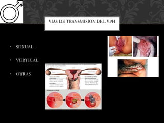 • SEXUAL
• VERTICAL
• OTRAS
VIAS DE TRANSMISION DEL VPH
 