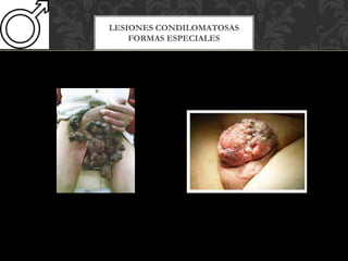 LESIONES CONDILOMATOSAS
FORMAS ESPECIALES
 