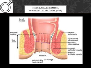 NEOPLASIA ESCAMOSA
INTRAEPITELIAL ANAL (NIA)
 