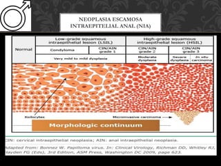 NEOPLASIA ESCAMOSA
INTRAEPITELIAL ANAL (NIA)
 