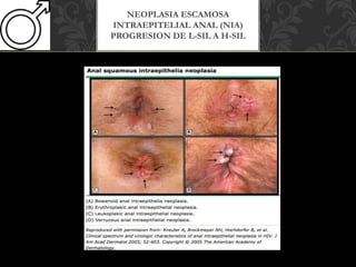 NEOPLASIA ESCAMOSA
INTRAEPITELIAL ANAL (NIA)
PROGRESION DE L-SIL A H-SIL
 