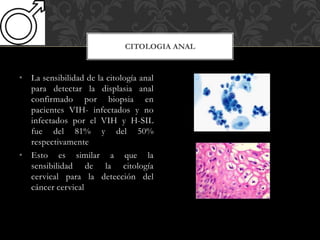 • La sensibilidad de la citología anal
para detectar la displasia anal
confirmado por biopsia en
pacientes VIH- infectados y no
infectados por el VIH y H-SIL
fue del 81% y del 50%
respectivamente
• Esto es similar a que la
sensibilidad de la citología
cervical para la detección del
cáncer cervical
CITOLOGIA ANAL
 