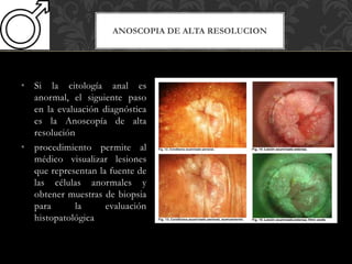 ANOSCOPIA DE ALTA RESOLUCION
• Si la citología anal es
anormal, el siguiente paso
en la evaluación diagnóstica
es la Anoscopía de alta
resolución
• procedimiento permite al
médico visualizar lesiones
que representan la fuente de
las células anormales y
obtener muestras de biopsia
para la evaluación
histopatológica
 