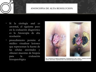 ANOSCOPIA DE ALTA RESOLUCION
• Si la citología anal es
anormal, el siguiente paso
en la evaluación diagnóstica
es la Anoscopía de alta
resolución
• procedimiento permite al
médico visualizar lesiones
que representan la fuente de
las células anormales y
obtener muestras de biopsia
para la evaluación
histopatológica
 