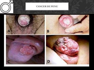 CANCER DE PENE
 