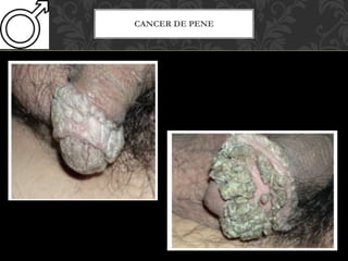 CANCER DE PENE
 