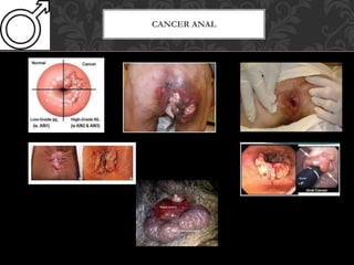 CANCER ANAL
 