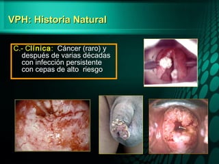 VPH: Historia NaturalVPH: Historia Natural
C.- Clínica: Cáncer (raro) y
después de varias décadas
con infección persistente
con cepas de alto riesgo
F
R
F
R
 