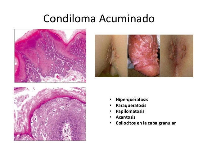 Vph histopatologia Vph histopatologia