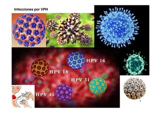 1
1
Infecciones por VPH
 