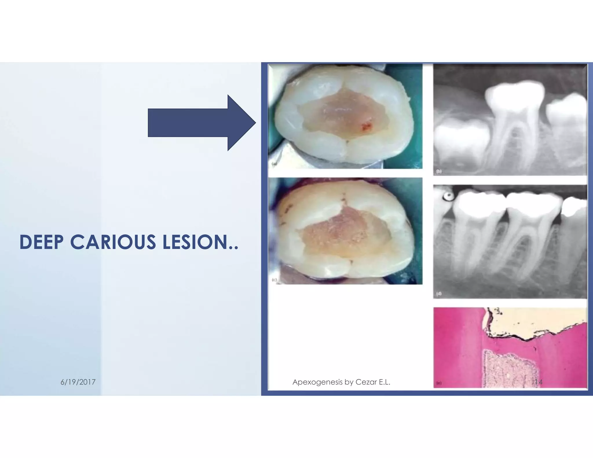 DEEP CARIOUS LESION..
6/19/2017 Apexogenesis by Cezar E.L. 14
 