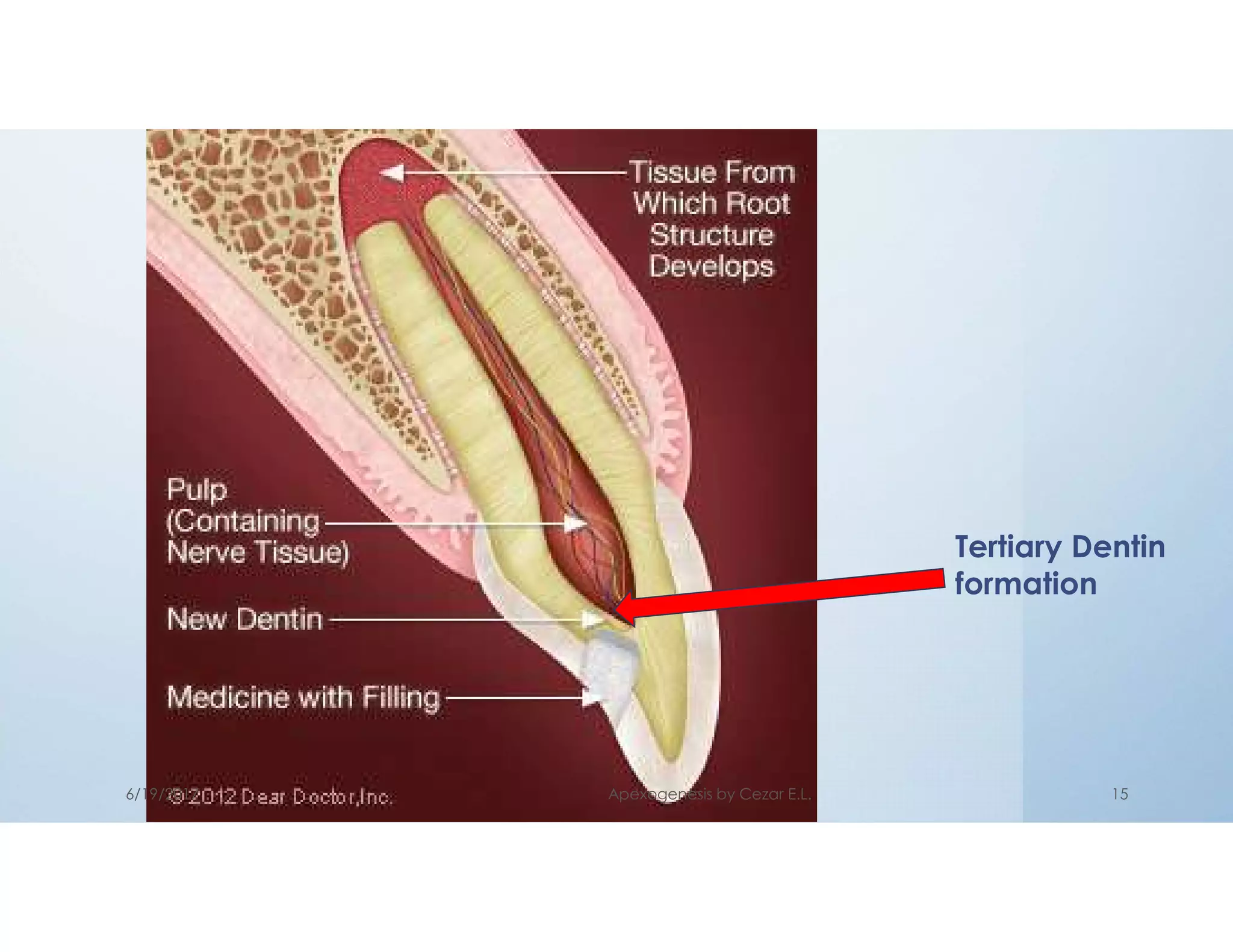 Tertiary Dentin
formation
6/19/2017 Apexogenesis by Cezar E.L. 15
 