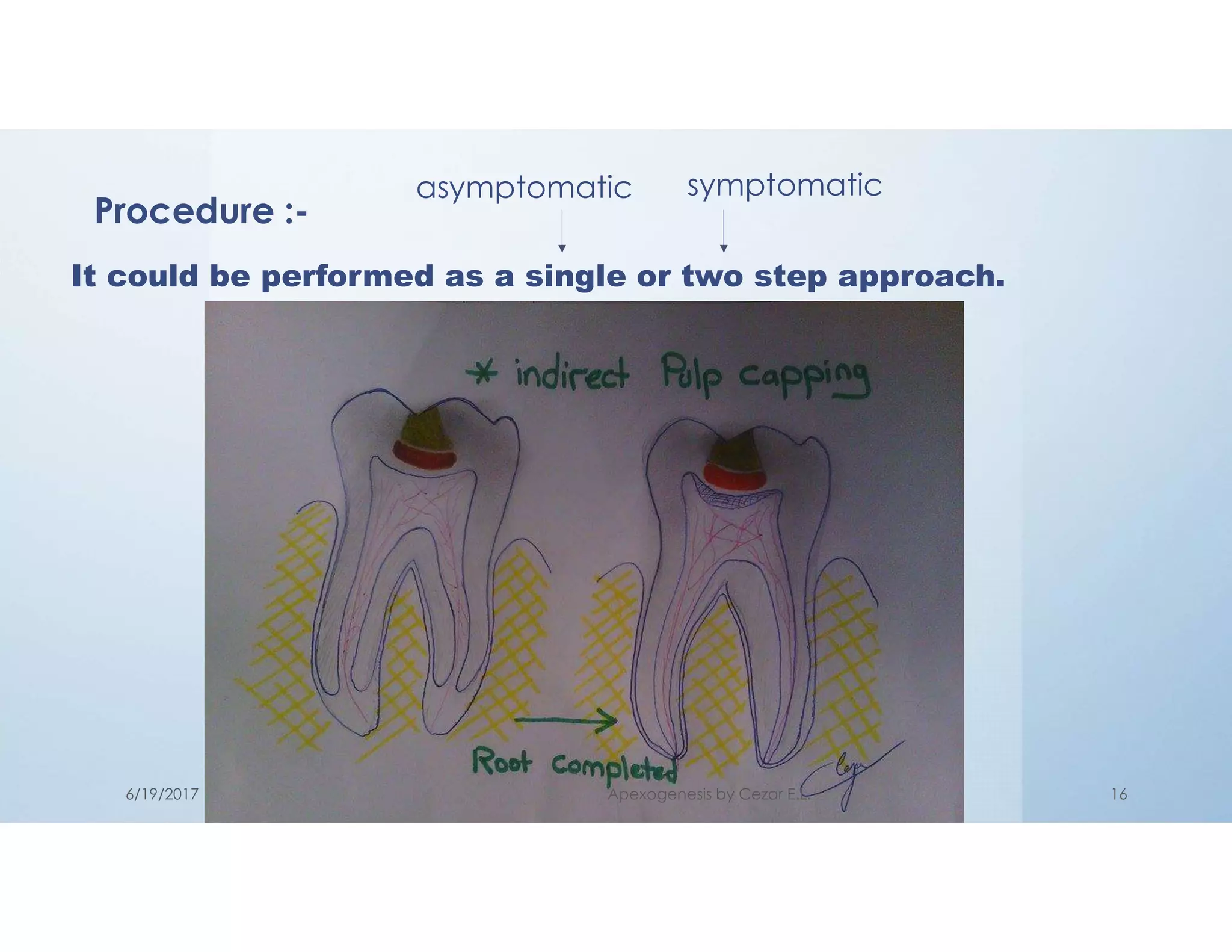 Procedure :-
It could be performed as a single or two step approach.
asymptomatic symptomatic
6/19/2017 Apexogenesis by Cezar E.L. 16
 