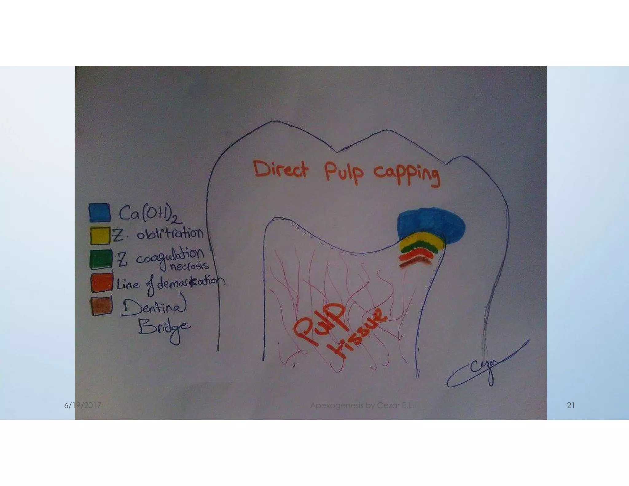 Tinal bridge
6/19/2017 Apexogenesis by Cezar E.L. 21
 