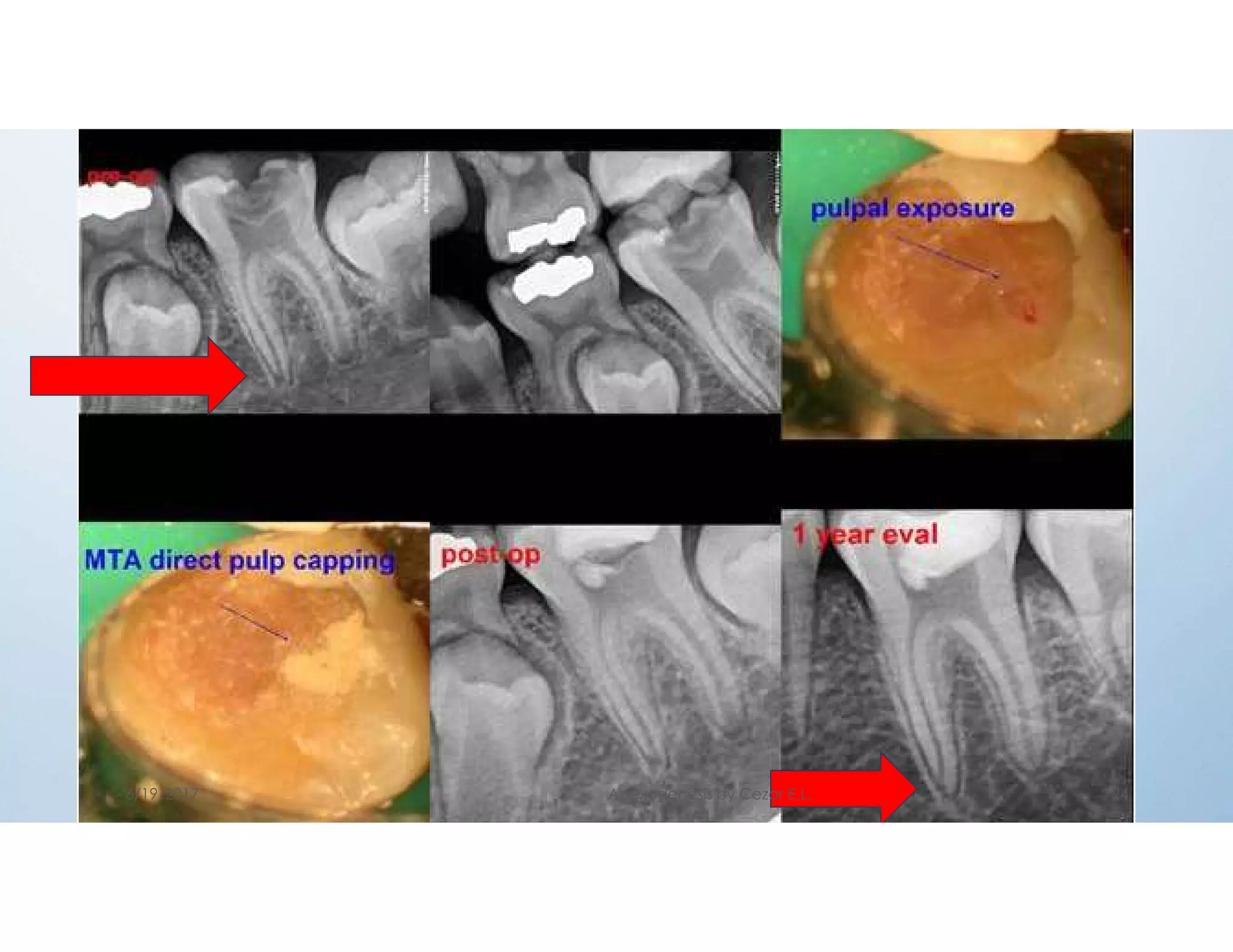 6/19/2017 Apexogenesis by Cezar E.L. 24
 