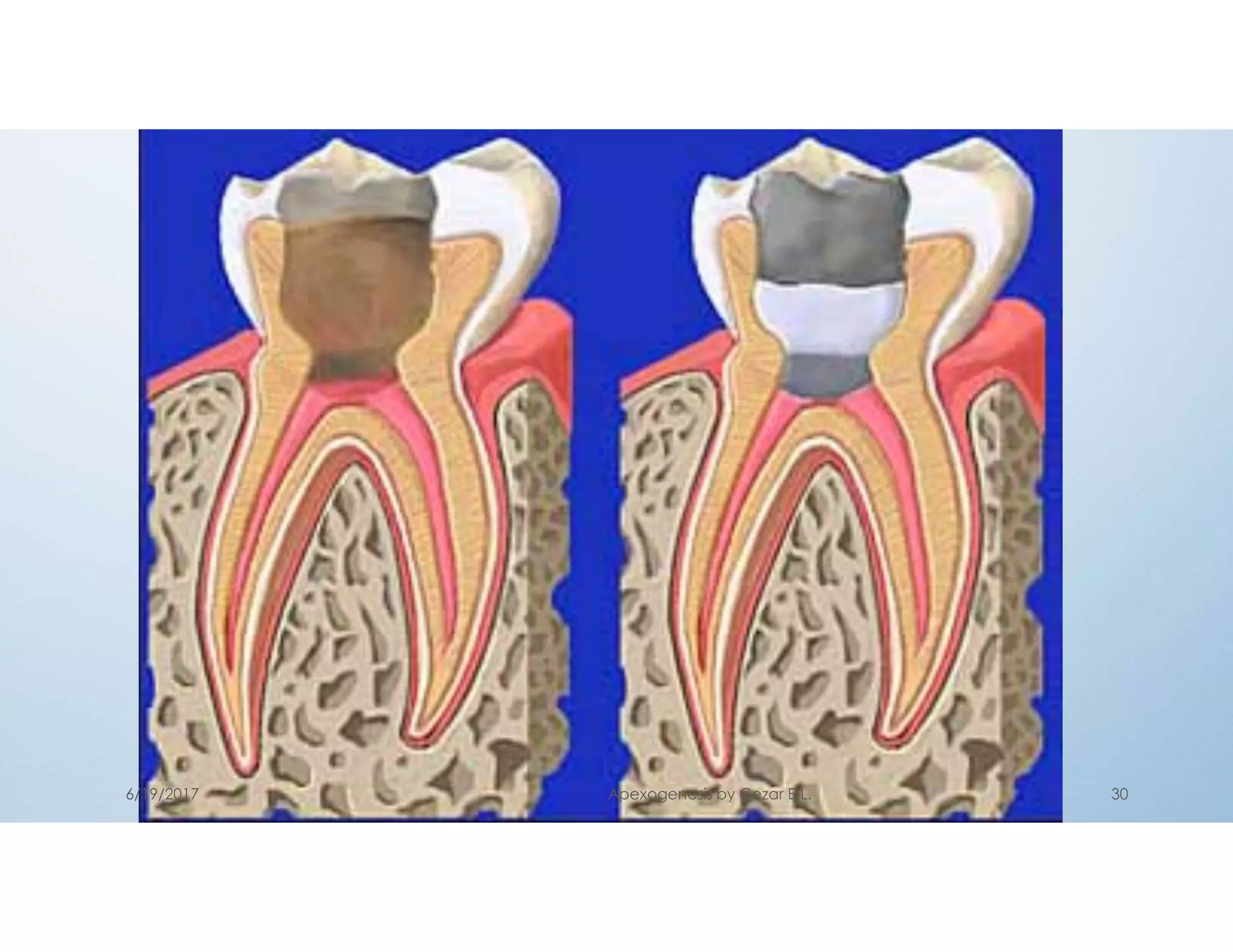 6/19/2017 Apexogenesis by Cezar E.L. 30
 