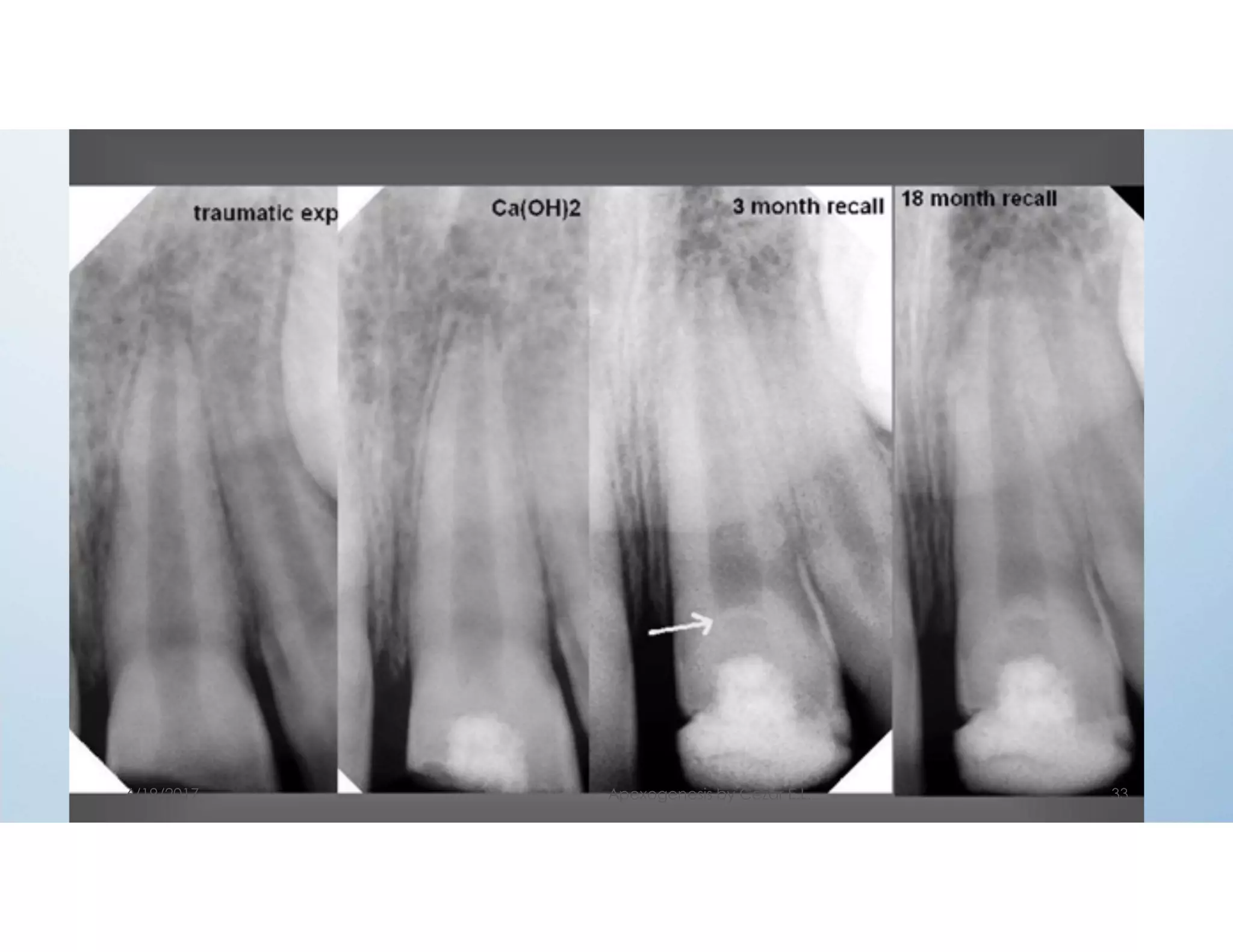 6/19/2017 Apexogenesis by Cezar E.L. 33
 
