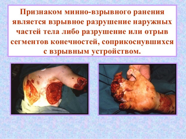 минно взрывные ранения фото онлайн минно взрывные ранения фото