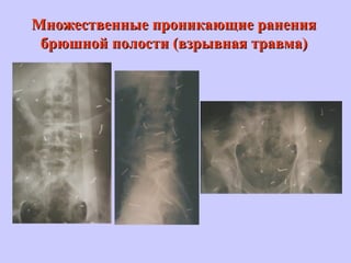Множественные проникающие раненияМножественные проникающие ранения
брюшной полости (взрывная травма)брюшной полости (взрывная травма)
 