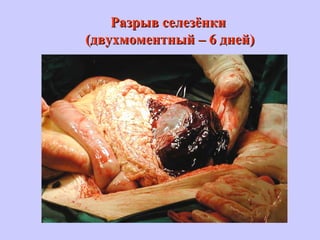 Разрыв селезёнкиРазрыв селезёнки
(двухмоментный – 6 дней)(двухмоментный – 6 дней)
 