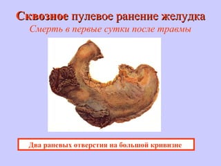 СквозноеСквозное пулевое ранение желудкапулевое ранение желудка
Смерть в первые сутки после травмы
Два раневых отверстия на большой кривизне
 
