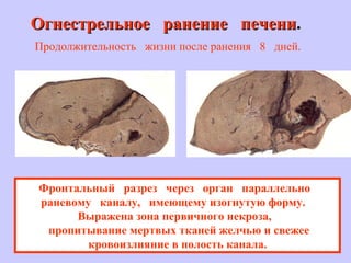 Огнестрельное ранение печениОгнестрельное ранение печени..
Продолжительность жизни после ранения 8 дней.
Фронтальный разрез через орган параллельно
раневому каналу, имеющему изогнутую форму.
Выражена зона первичного некроза,
пропитывание мертвых тканей желчью и свежее
кровоизлияние в полость канала.
 