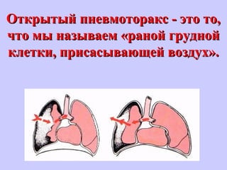 Открытый пневмоторакс - это то,Открытый пневмоторакс - это то,
что мы называем «раной груднойчто мы называем «раной грудной
клетки, присасывающей воздух».клетки, присасывающей воздух».
 
