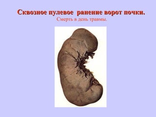 Сквозное пулевое ранение ворот почки.Сквозное пулевое ранение ворот почки.
Смерть в день травмы.
 