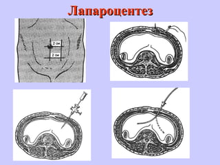 ЛапароцентезЛапароцентез
 