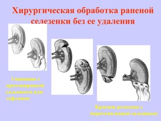 Хирургическая обработка раненой
селезенки без ее удаления
Ушивание с
протежировкой
сальником или
тефлоном
Краевая резекция с
перитонизацией сальником
 