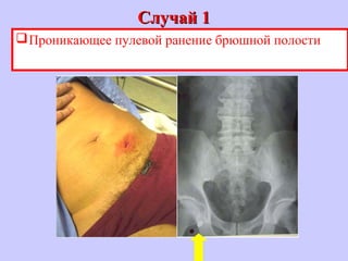 Случай 1Случай 1
Проникающее пулевой ранение брюшной полости
 