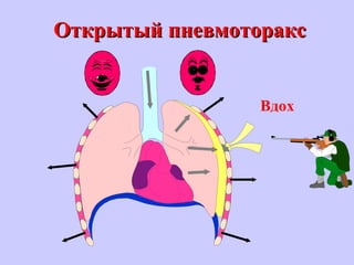 Открытый пневмотораксОткрытый пневмоторакс
Вдох
 