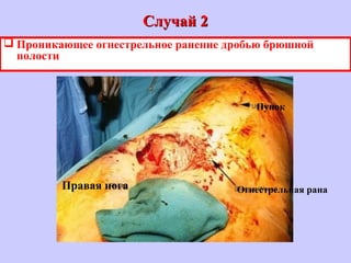 Случай 2Случай 2
 Проникающее огнестрельное ранение дробью брюшной
полости
Огнестрельная рана
Пупок
Правая нога
 