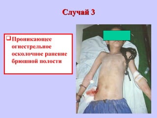 Случай 3Случай 3
Проникающее
огнестрельное
осколочное ранение
брюшной полости
 