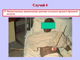Случай 4Случай 4
 Множественные проникающие ранения холодным оружием брюшной
полости
 