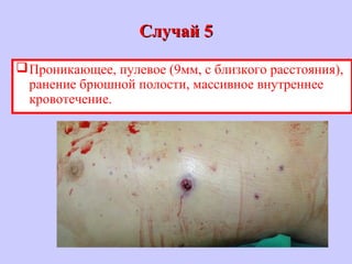 Случай 5Случай 5
Проникающее, пулевое (9мм, с близкого расстояния),
ранение брюшной полости, массивное внутреннее
кровотечение.
 