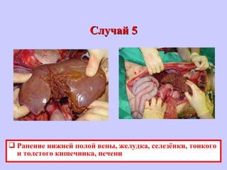 Случай 5Случай 5
 Ранение нижней полой вены, желудка, селезёнки, тонкого
и толстого кишечника, печени
 