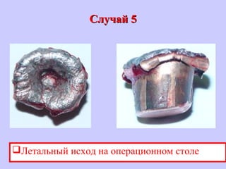 Случай 5Случай 5
Летальный исход на операционном столе
 